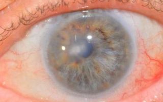 Кератопатия глаза и ее виды — причины, симптомы и лечение