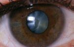Начальная стадия катаракты — симптомы и лечение. что делать при появлении начальной катаракты