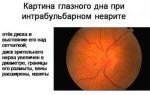 Неврит зрительного нерва – причины, симптомы и лечение