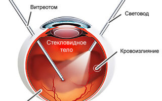 Заболевание дистрофия сетчатки глаза — что это такое?