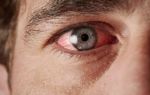 Раздражение глаз: причины и как снять в домашних условиях