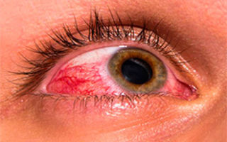 Как снизить глазное давление в домашних условиях, лечение внутриглазного давления