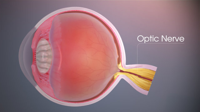 Отек зрительного нерва – причины, симптомы и лечение отека