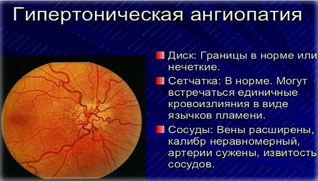 Ангиопатия сетчатки глаза – причины, симптомы и лечение