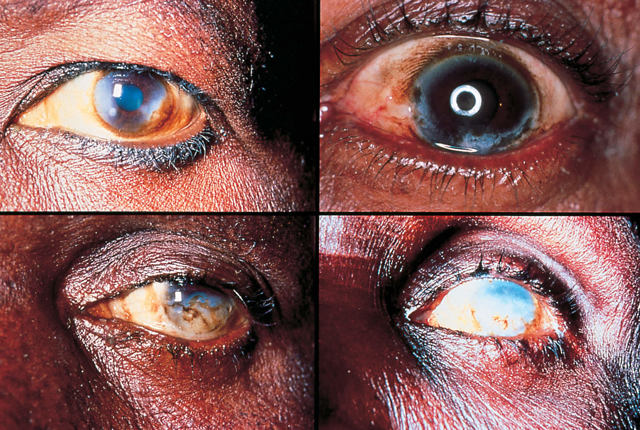 Онхоцеркоз (речная слепота) – причины, симптомы и лечение