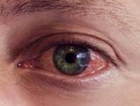 Конъюнктивит глаз – причины, симптомы и лечение у взрослых. Виды конъюнктивита.