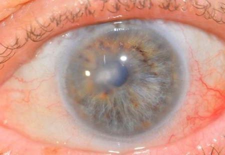 Кератопатия глаза и ее виды — причины, симптомы и лечение