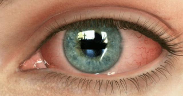 Ожоги глаз – виды, первая помощь и лечение ожогов