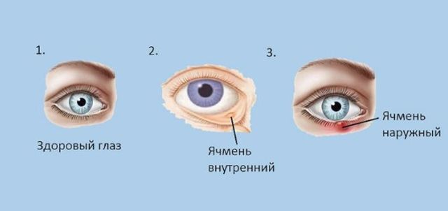 Заразен ли ячмень на глазу, передается окружающим или нет