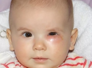 Дакриоцистит у новорожденных — симптомы и лечение (фото)