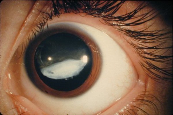 Глазное давление – причины, симптомы и лечение. Признаки высокого внутриглазного давления
