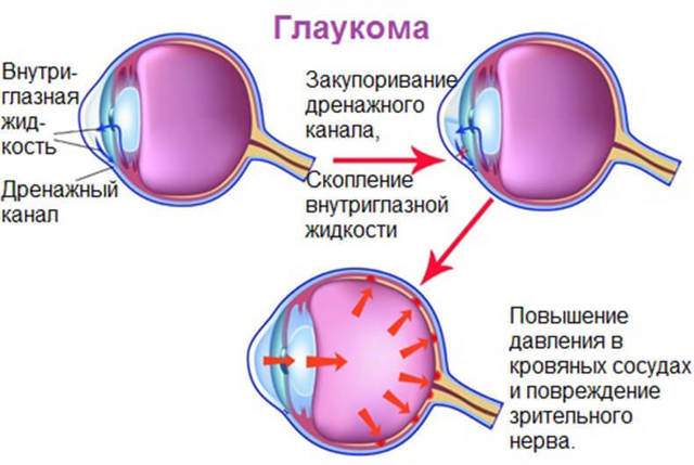 Вторичная глаукома – классификация, причины и лечение (фото)