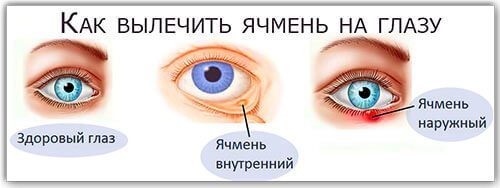 Как предотвратить ячмень на глазу — профилактика ячменя