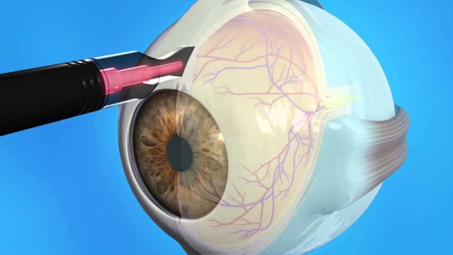 Операция глаукомы – виды, как делается и последствия