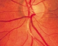 Гипертоническая ретинопатия глаза – симптомы и профилактика