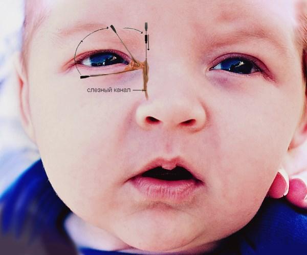 Дакриоцистит у новорожденных — симптомы и лечение (фото)