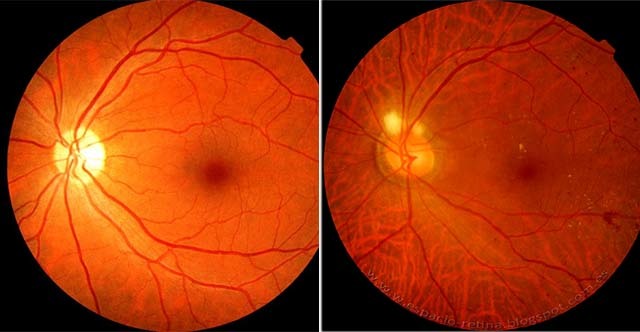 Отек сетчатки глаза – причины и лечение