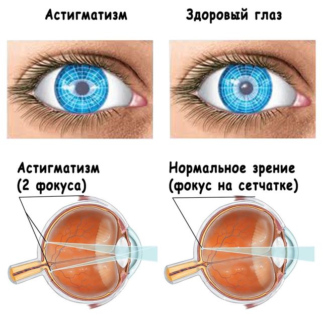 Астигматизм глаз — что это и как лечить, причины и симптомы заболевания
