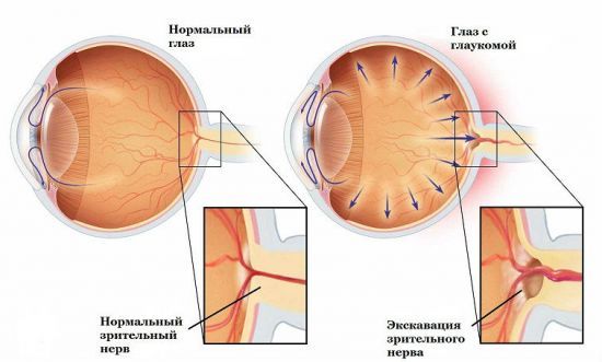 Как снизить глазное давление в домашних условиях, лечение внутриглазного давления