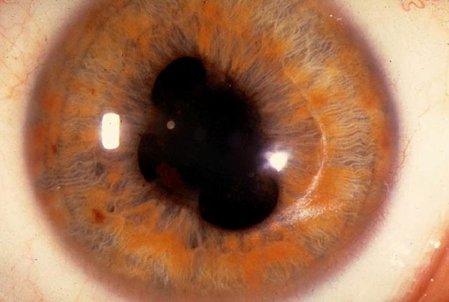 Коломба радужки глаза: причины и лечение, колобома у ребенка (фото)