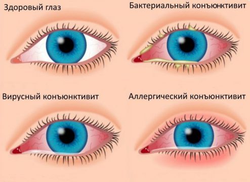 Белые выделения из глаз у взрослых: причины и лечение