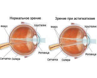 Лечение астигматизма глаз у взрослых — причины и симптомы болезни