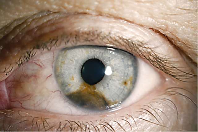 Меланома хориоидеи глаза — причины, симптомы и лечение
