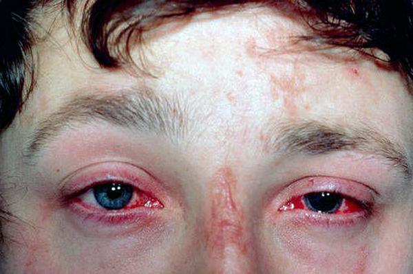 Ожог глаз перцовым баллончиком – что делать, первая помощь и лечение