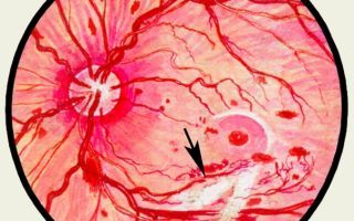 Повреждение зрительного нерва – причины, симптомы и лечение