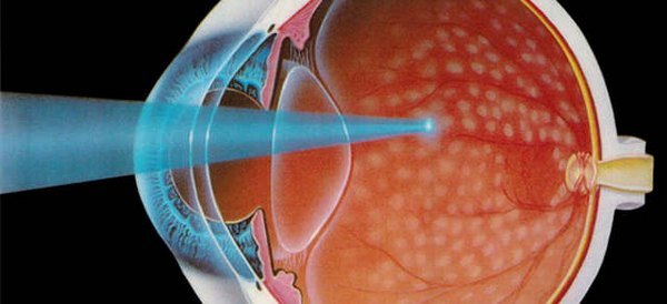 Заболевание дистрофия сетчатки глаза - что это такое?