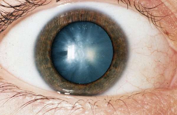 Лечение катаракты народными средствами без операции в домашних условиях