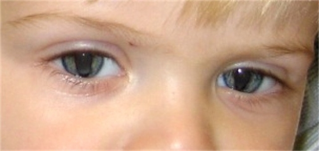 Коломба радужки глаза: причины и лечение, колобома у ребенка (фото)