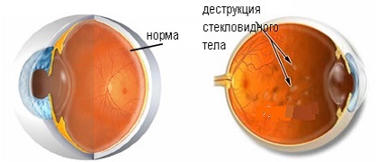 Деструкция стекловидного тела глаза – симптомы и лечение