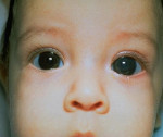 Врожденная глаукома – причины, симптомы и лечение у детей и взрослых