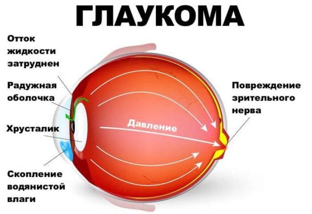 Выпадение полей зрения (причины и лечение)