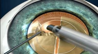 Лечение катаракты лазером – стоимость операции