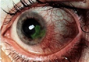 Бельмо на глазу у человека – причины, симптомы и лечение