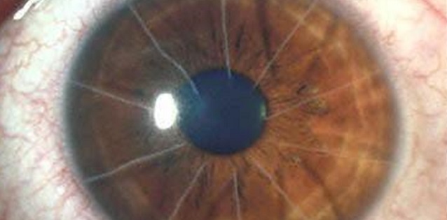 Лазерная коррекция зрения при дальнозоркости (операция)