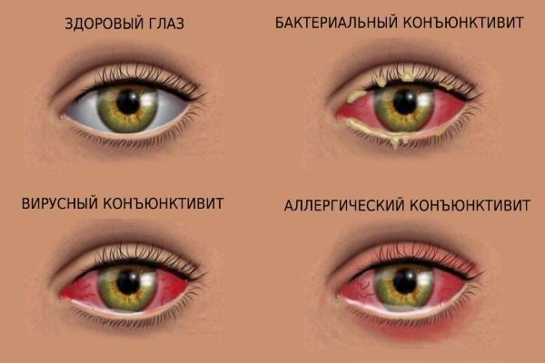 Конъюнктивит глаз – причины, симптомы и лечение у взрослых. Виды конъюнктивита.