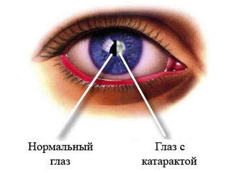 Какой лучше выбрать хрусталик для глаза при катаракте – стоимость хрусталика