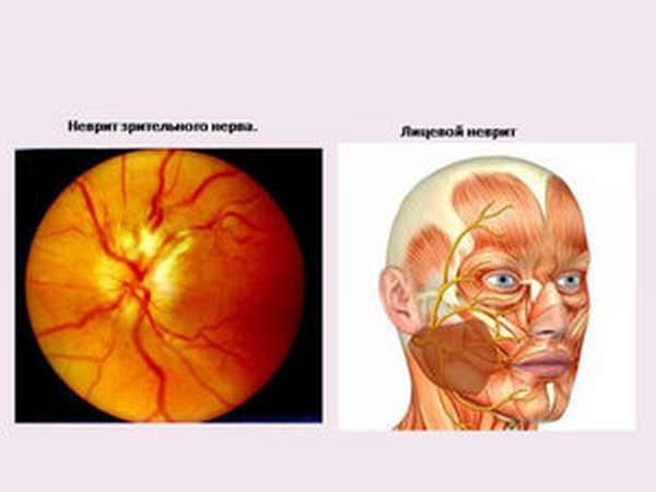 Неврит зрительного нерва – причины, симптомы и лечение