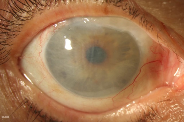 Отек роговицы глаза – симптомы и лечение
