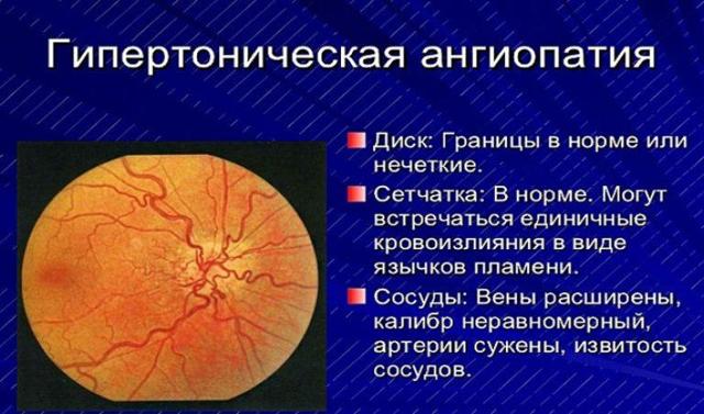 Ангиопатия сетчатки глаза у детей — причины, симптомы и лечение