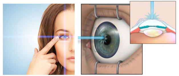 Операция на глаза близорукость – виды и стоимость, коррекция миопии