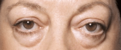 Грыжи под глазами – причины и лечение без операции, народными средствами и хирургическим путем