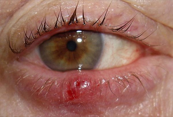 Народные средства от ячменя на глазу — лечение пивными дрожжами, ромашкой, алоэ и др.