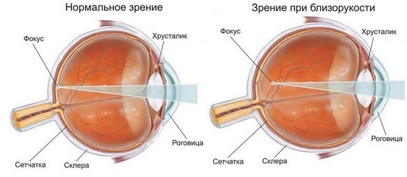 Близорукость (миопия) – причины, симптомы и лечение заболевания глаз