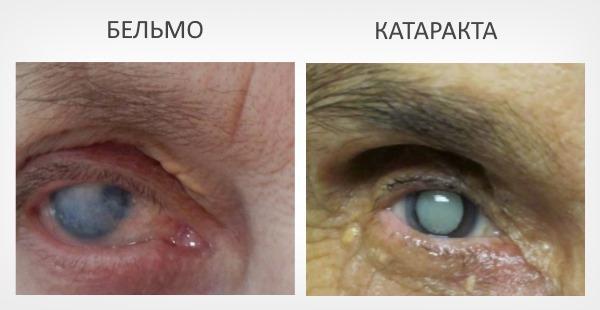 Бельмо на глазу у человека – причины, симптомы и лечение