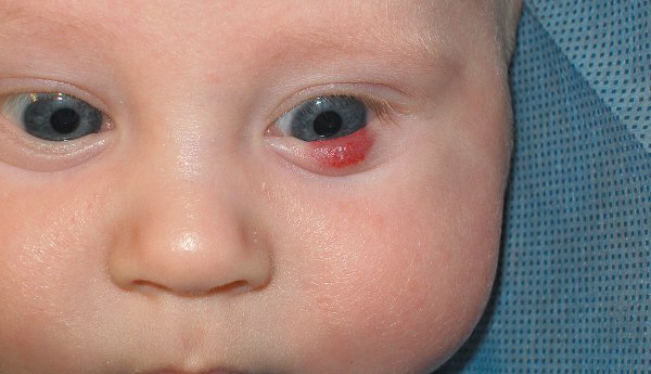 Гемангиома на веке у детей — причины, симптомы и лечение