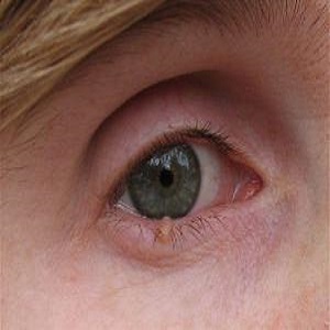 Невус хориоидеи на глазу – виды, симптомы и лечение (фото)